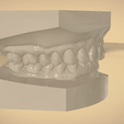 Screenshot_29.png Digital Orthodontic Study Models with Virtual Bases