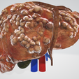fibrotic-LIVER,-abdominal,-abdomen,-spleen,-pancreas,-pancreatic,-biliary,-hepatic,-artery,-vein,-po.png 6 PIÈCES Modèle 3D réaliste du foie atteint de cirrhose (fibrose) - avec système biliaire, veines portales, veines et artères hépatiques, ligaments du foie