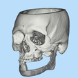 1.png Mandible implant-INDIVIDUAL PROSTHESIS FOR JAW RECONSTRUCTION