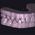 Pac-A-MAX-SUP-INF-Zocalado.png TRANSPARENT ALIGNERS Pac A. 21 dental models or setups of UPPER AND LOWER MAXILLARY "READY FOR 3D PRINTER" - AREA3D - PATIENT A. COMPLETE DENTURE