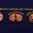 ps2.jpg Alzheimer Disease Brain coronal slice