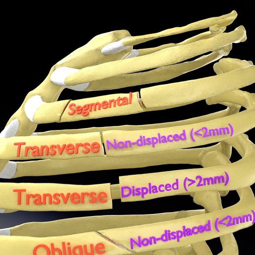 STL file Rib fracture and its types 🦴 ・Design to download and 3D print ...