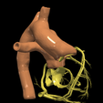 18.png 3D Model of Transposition of the Great Arteries Open Duct