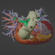 5.png Model of human heart with pulmonary atresia (PuA) - generated from real patient