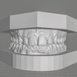 moei-cults.jpg Dental Orthodontic Study Model with  Bases