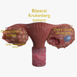 1200.png Krukenberg ovarian cancer tumor