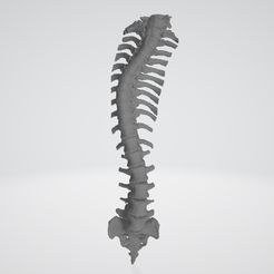 1.jpg Scoliosis spine 1