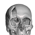 Captura-de-Pantalla-2023-08-22-a-la-s-6.35.00-p. m.png skull fracture / skull fracture
