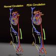 ps-0003.jpg PDA Patent Ductus Arteriosus vs Normal blood circulation