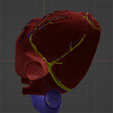 9.png 3D Model of Heart with Transposition of the Great Arteries, long axis view