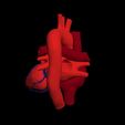 i2.jpg 3D Model of Heart with Atrial Septal Defect
