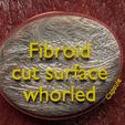 0027.jpg Fibroid Uterus Human female 3D