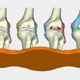 6.jpg total knee replacement model ( TKR ), EDUCATING / TEACHING MODEL