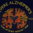 ps23.jpg Alzheimer Disease Brain coronal slice