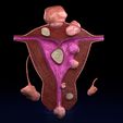sig.jpg Fibroid Uterus Human female 3D