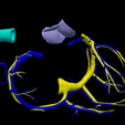 9.png 3D Model of Partial Anomalous Pulmonary Venous Connection
