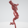 p3.png Case 1 to 6: 3D aortic and iliac artery aneurysm