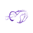 papvcarteries2.stl 3D Model of Partial Anomalous Pulmonary Venous Connection