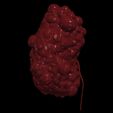 5.jpg 3D Model of Polycystic Kidney