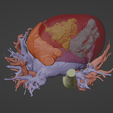6.png 3D Model of Human Heart with Ventricular Septal Defect (VSD)