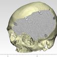 Skull_porous_plate_1.jpeg Cranial plate made according to anthropometric data (an interesting case)