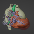 3.png Model of human heart with pulmonary atresia (PuA) - generated from real patient