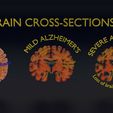 ps19.jpg Alzheimer Disease Brain coronal slice