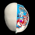 i10.jpg 3D Model of Brain Arteriovenous Malformation