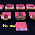 gastric-stomach-cancer-stages-labelled-3d-model-7e3cc96b2d.jpg Gastric stomach cancer stages labelled 3D model