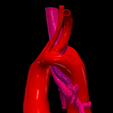 6.png 3D Model of Double Aortic Arch