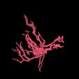 7.jpg 3D Model of Middle Cerebral Artery (MCA) Aneurysm