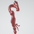 p3.png Case 1 to 6: 3D aortic and iliac artery aneurysm