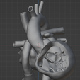 9.png 3D Model of Heart after Fontan Procedure