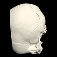 14.jpg 3D Model of Middle Cerebral Artery (MCA) Aneurysm