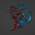 w8.png 3D Model of Brain Arteriovenous Malformation