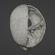w15.png 3D Model of Brain Arteriovenous Malformation