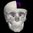 05.jpg 3D Model of Brain Arteriovenous Malformation
