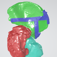 Picture1.png Sarcoma pélvico impresso em 3D e guia de corte 2