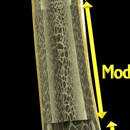 Image-0009.jpg Osteoporosis and its stages