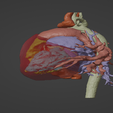 2.png 3D Model of Human Heart with Ventricular Septal Defect (VSD)