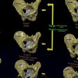pelvis-fracture-classifications-3d-model-blend-41.jpg Pelvis fracture classifications 3D model