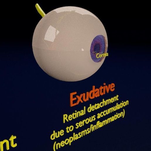 retinal-detachment-types-eye-3d-model-blend-89.jpg Retinal detachment types eye 3D model