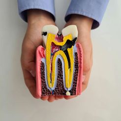diente-picado-por-dentro.jpg Tooth with caries