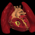 4.png 3D Model of Transposition of the Great Arteries Open Duct