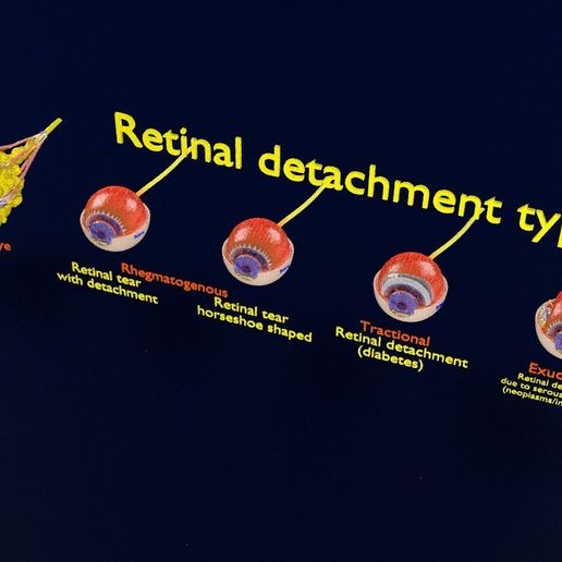 retinal-detachment-types-eye-3d-model-blend-66.jpg Retinal detachment types eye 3D model