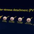 posterior-vitreous-detachment-types-eye-3d-model-blend-78.jpg Posterior vitreous detachment types eye 3D model