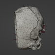 t4.png 3D Model of Middle Cerebral Artery (MCA) Aneurysm