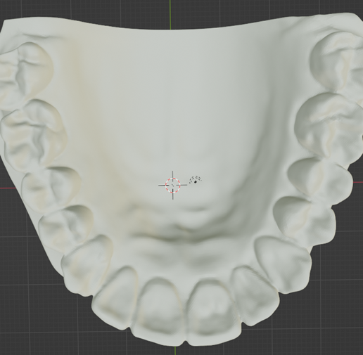 molar-distalizer,-teeth,-dental,-tooth,-palatal-expander,-appliance,-removable,-hilgers,-orthodontic.png High resolution Rapid Palatal Expander (Banded type) Dental appliance on Upper teeth