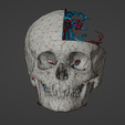 w1.png 3D Model of Brain Arteriovenous Malformation
