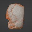 w5.png 3D Model of Middle Cerebral Artery (MCA) Aneurysm